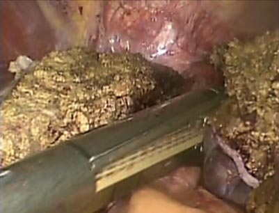 腹腔鏡下肝外側区域切除術