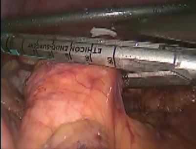 腹腔鏡下膵体尾部切除術