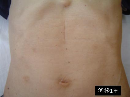腹腔鏡における術創