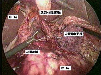腹腔鏡補助下幽門側胃切除術