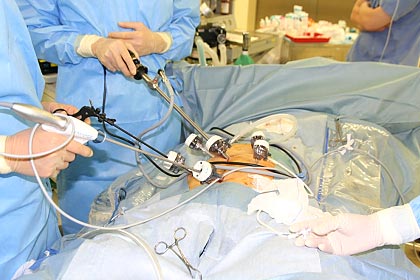 腹腔鏡の手術2