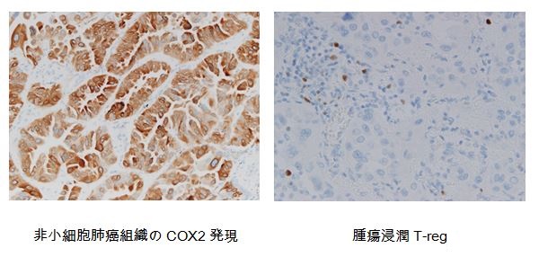 非小細胞肺癌組織のCOX2発現、腫瘍浸潤T-reg
