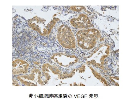 非小細胞肺癌組織のVEGF発現
